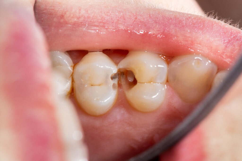 cavity that requires Emergency Dentistry Summerfield FL